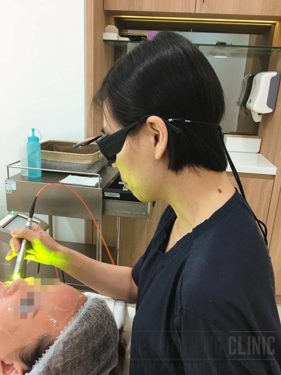 Laser Treatments for Acne and Acne Scars Peter Ch'ng Skin Specialist